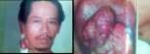 Tumor
